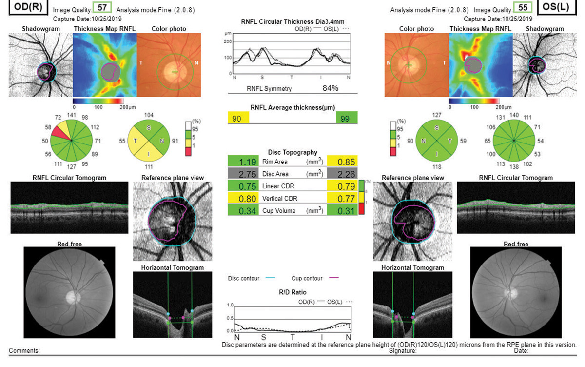 OCT scan showing optic nerve fiber thickness in both eyes — the right eye shows early glaucomatous changes